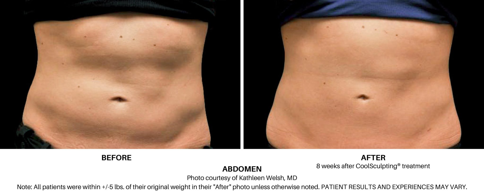 Coolsculpting Elite Before and After on Female Abdomen Always Beautiful Coolsculpting