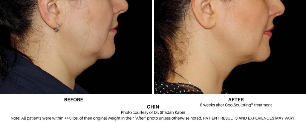 Coolsculpting Elite Chin Before and After Always Beautiful Coolsculpting