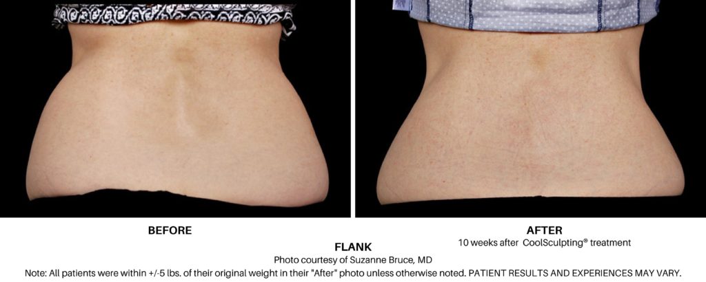 Coolsculpting Elite Before and After on Female Flank Always Beautiful Coolsculpting