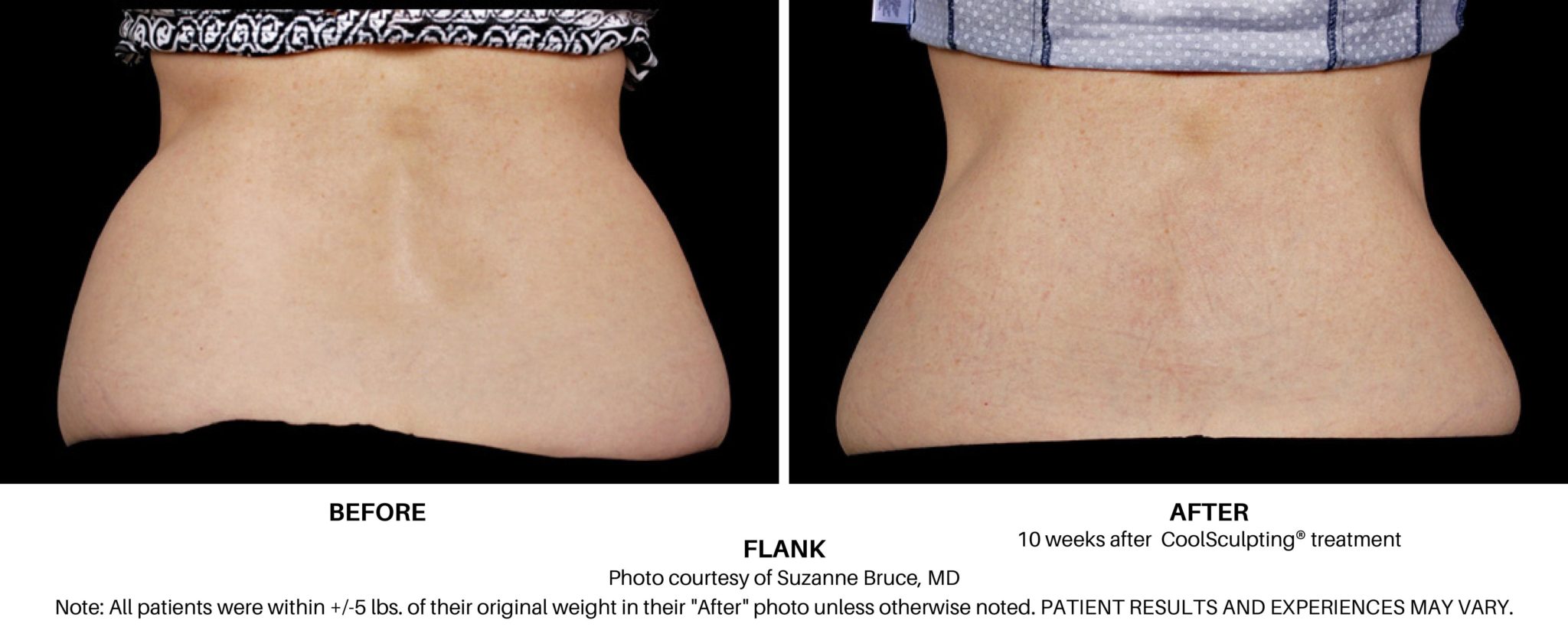 Liposuction of the Love Handles or Flanks  Reduce Sides, Love Handles and  Flanks with Liposuction 