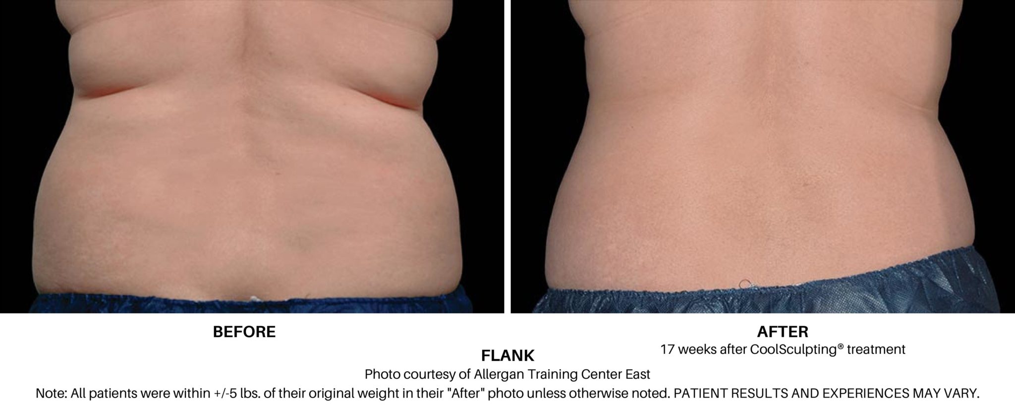 Eliminate Love Handles with Liposuction of the Flanks!