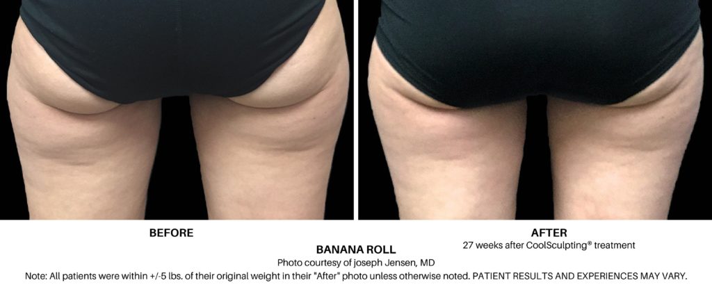 Coolsculpting Elite Before and After on Female Banana Roll Always Beautiful Coolsculpting