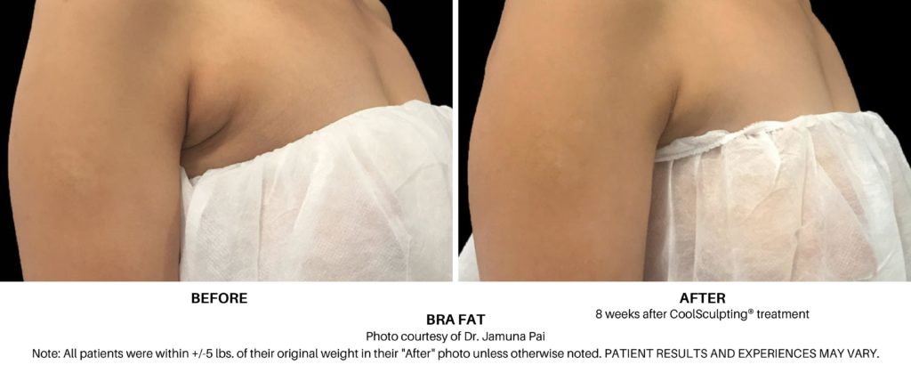 Coolsculpting Elite Before and After on Bra Fat Always Beautiful Coolsculpting