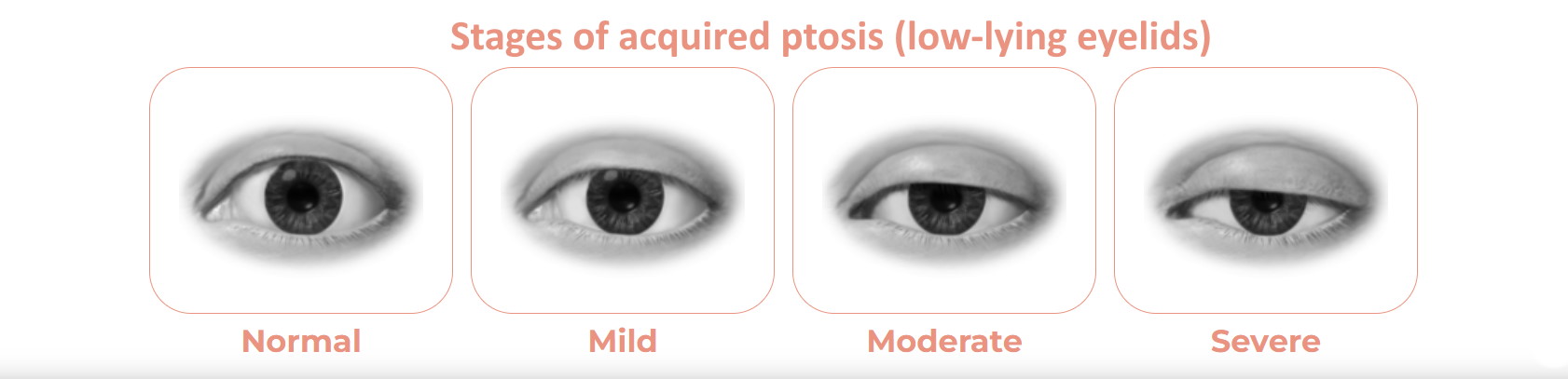 acquired ptosis graphic showing low eyelids