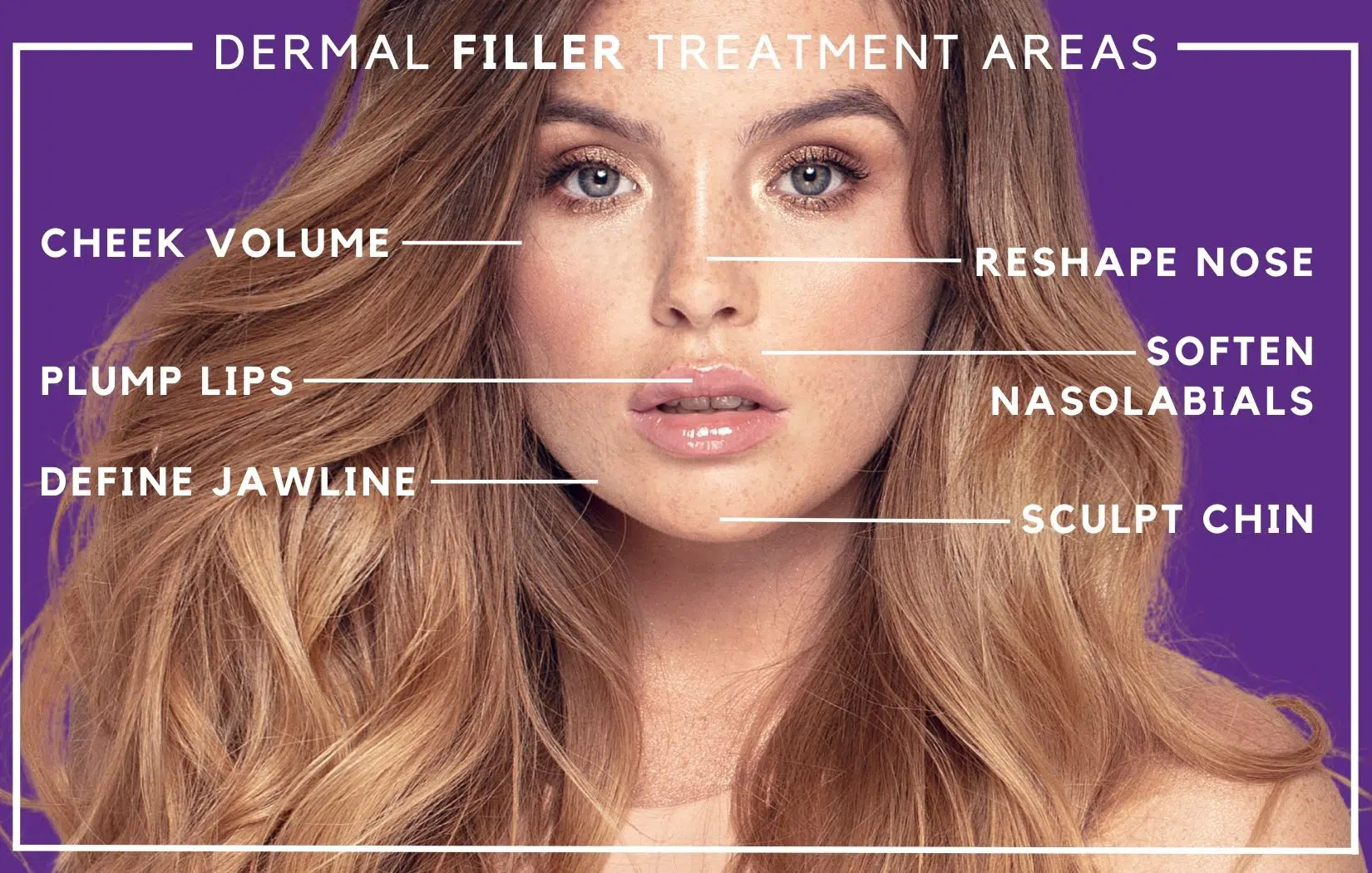 Dermal filler treatment area graphic