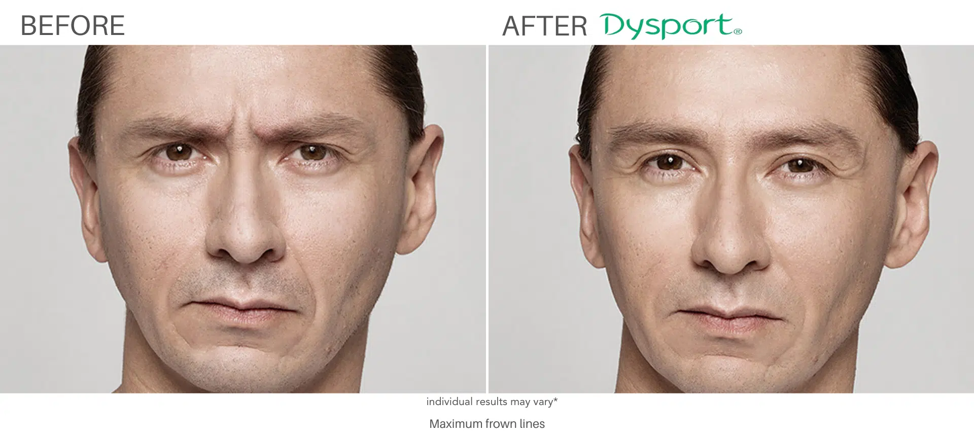 Man Frown LInes before and after Dysport treatment at always beautiful, Denver CO