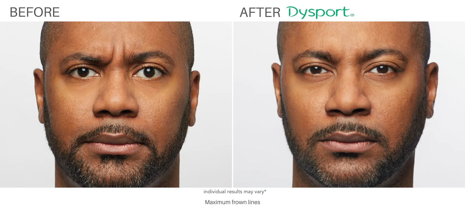 Man Frown LInes before and after Dysport treatment at always beautiful, Denver CO