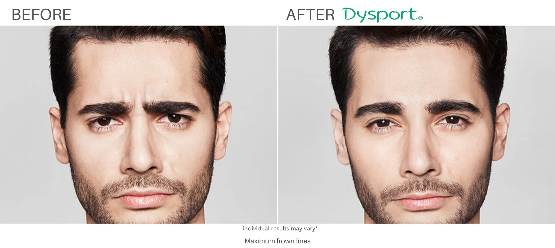 Man Frown LInes before and after Dysport treatment at always beautiful, Denver CO