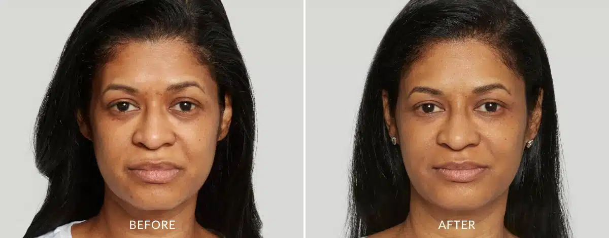 Before and after photo of a woman from Sculptra injection in Aurora, CO