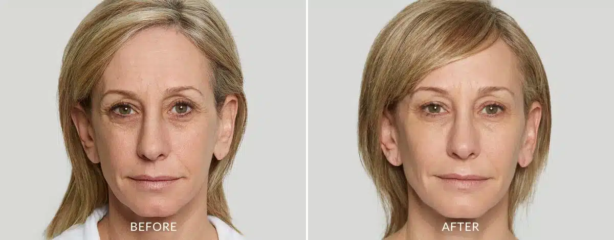Sculptra injection before and after photo of a lady in Aurora, CO