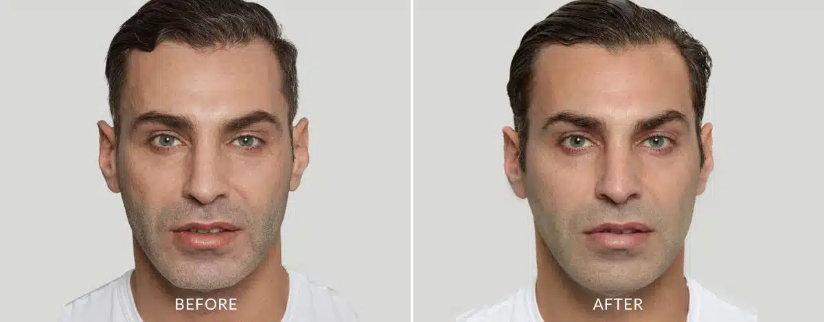 Before and after photo of a man from Sculptra injection in Aurora, CO