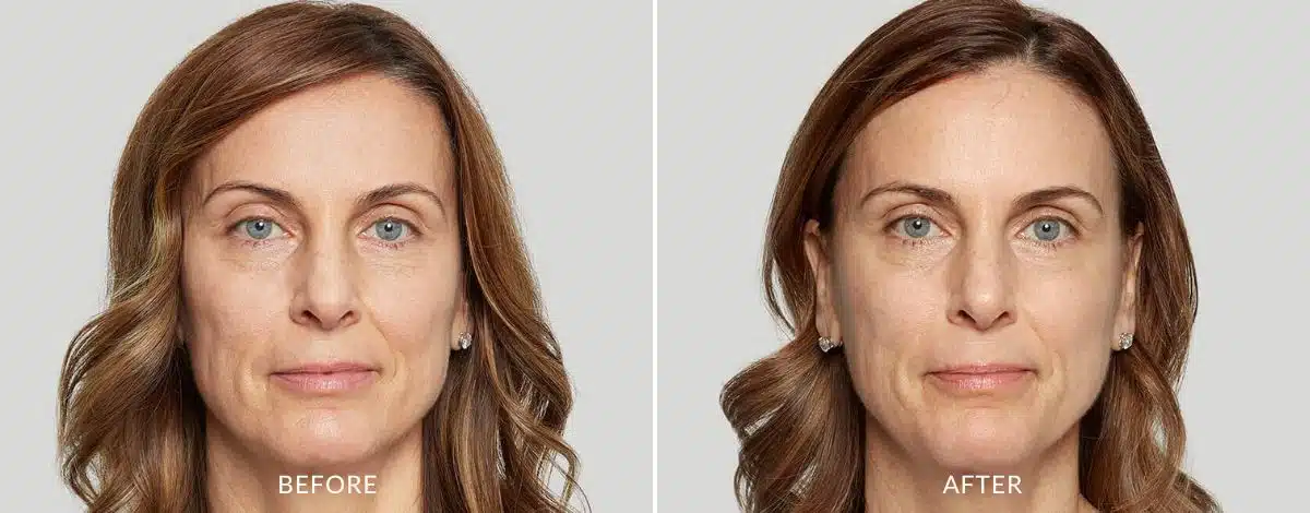 Before and after image of a woman from Sculptra injection in Aurora, Colorado