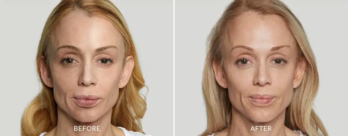 An image showing before and after treatment of a woman from a Sculptra injection in Aurora, CO.