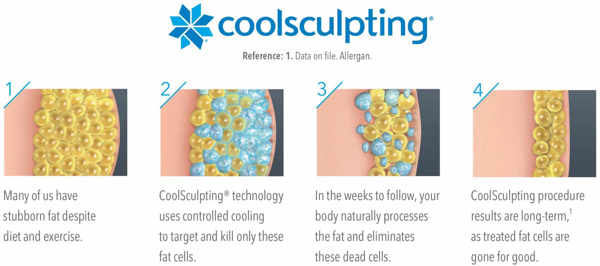Coolsculpting.jpg Coolsculpting.jpg