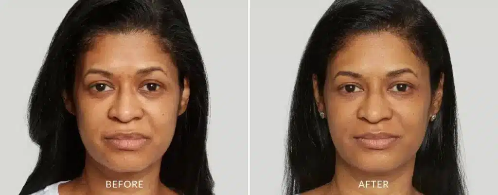 Sculptra Always Beautiful Medspa Aurora CO before and after treatment image 1.jpg Sculptra Always Beautiful Medspa Aurora CO before and after treatment image 1.jpg