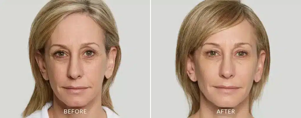 Sculptra Always Beautiful Medspa Aurora CO before and after treatment image 2.jpg Sculptra Always Beautiful Medspa Aurora CO before and after treatment image 2.jpg
