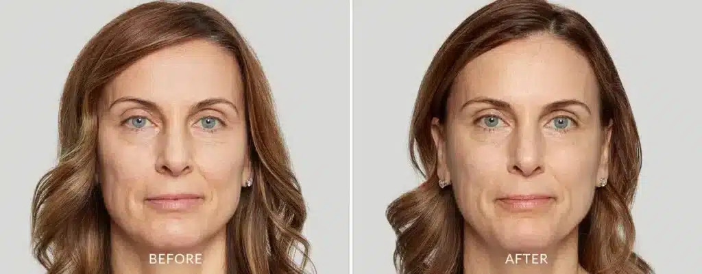 Sculptra Always Beautiful Medspa Aurora CO before and after treatment image 4.jpg Sculptra Always Beautiful Medspa Aurora CO before and after treatment image 4.jpg