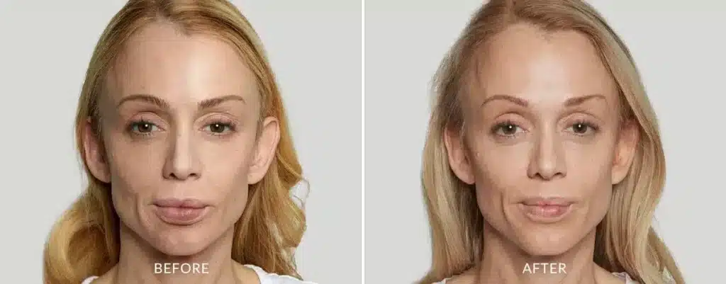 Sculptra Always Beautiful Medspa Aurora CO before and after treatment image 5.jpg Sculptra Always Beautiful Medspa Aurora CO before and after treatment image 5.jpg