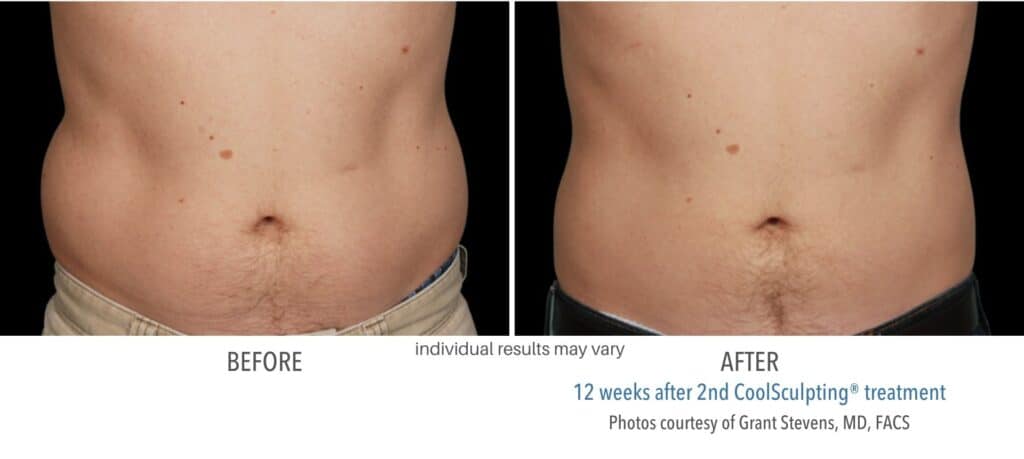coolsculpting before and after aurora 3 coolsculpting before and after aurora 3