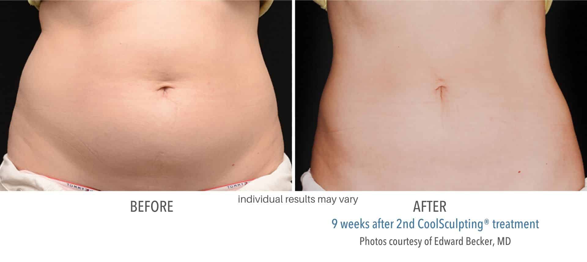 coolsculpting before and after aurora 4 coolsculpting before and after aurora 4