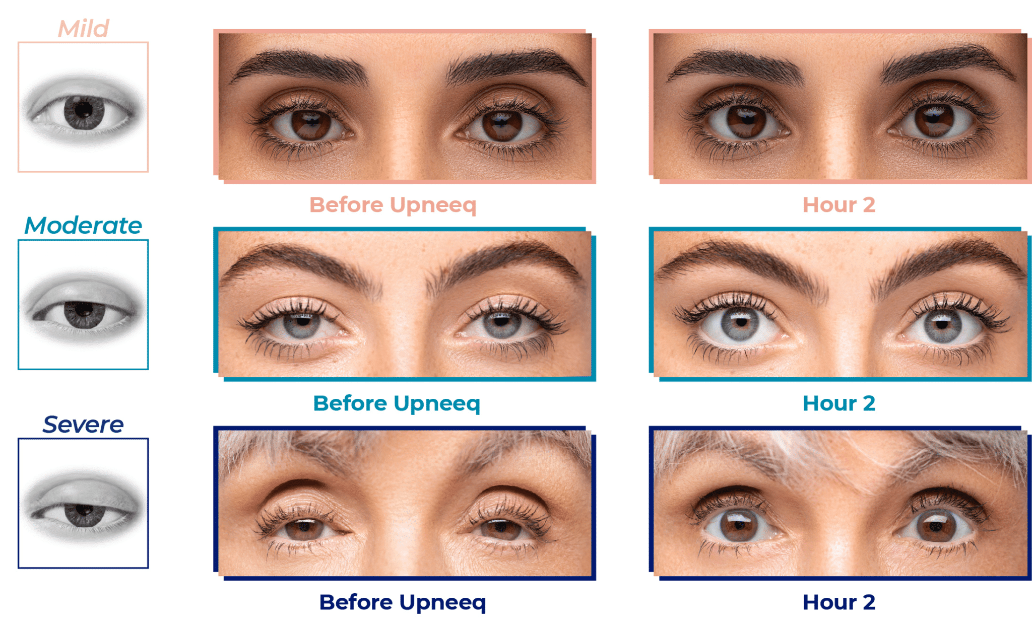 upneeq droopy eyelid treatment before and after 2 upneeq droopy eyelid treatment before and after 2