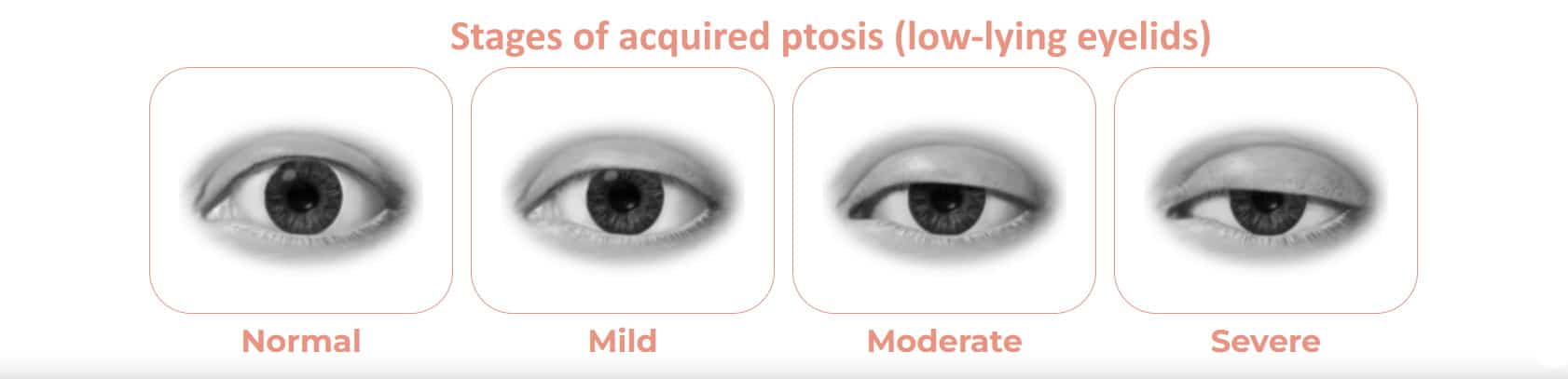 what is acquired ptosis what is acquired ptosis