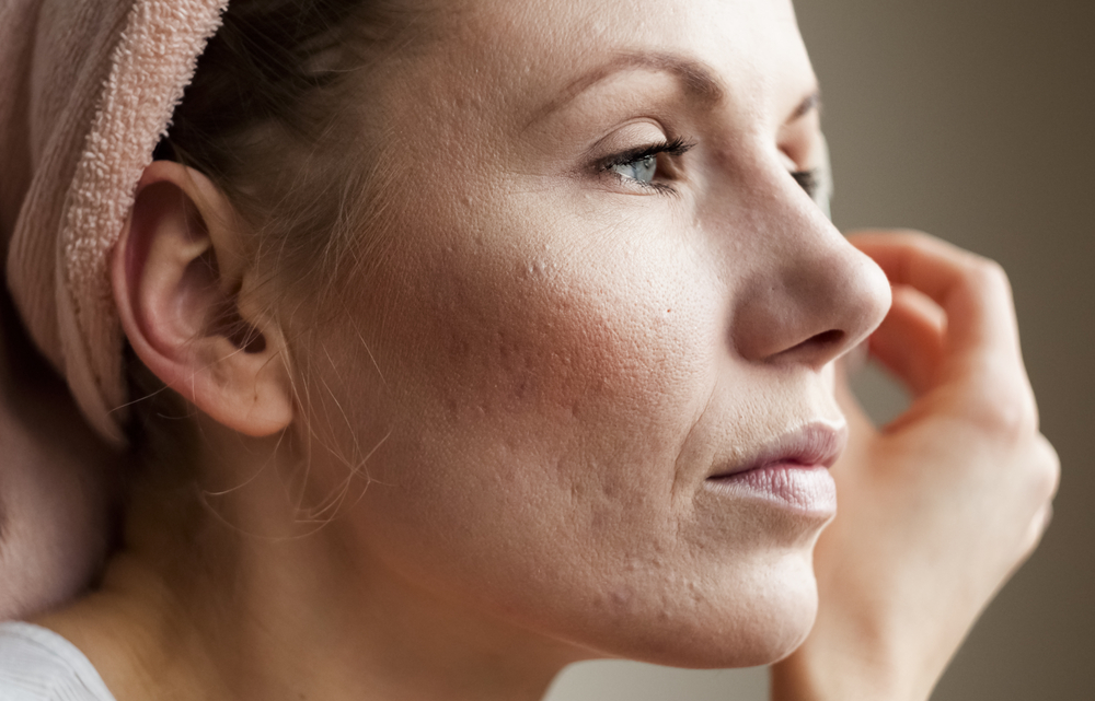 Close up of woman's facial skin with acne scars, considering Sculptra treatment in Denver, CO