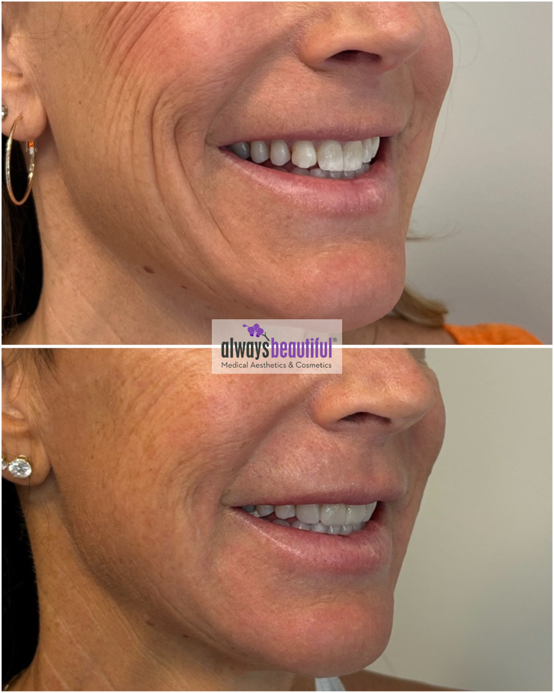 Before and After Image: Before and After - right-front-oblique