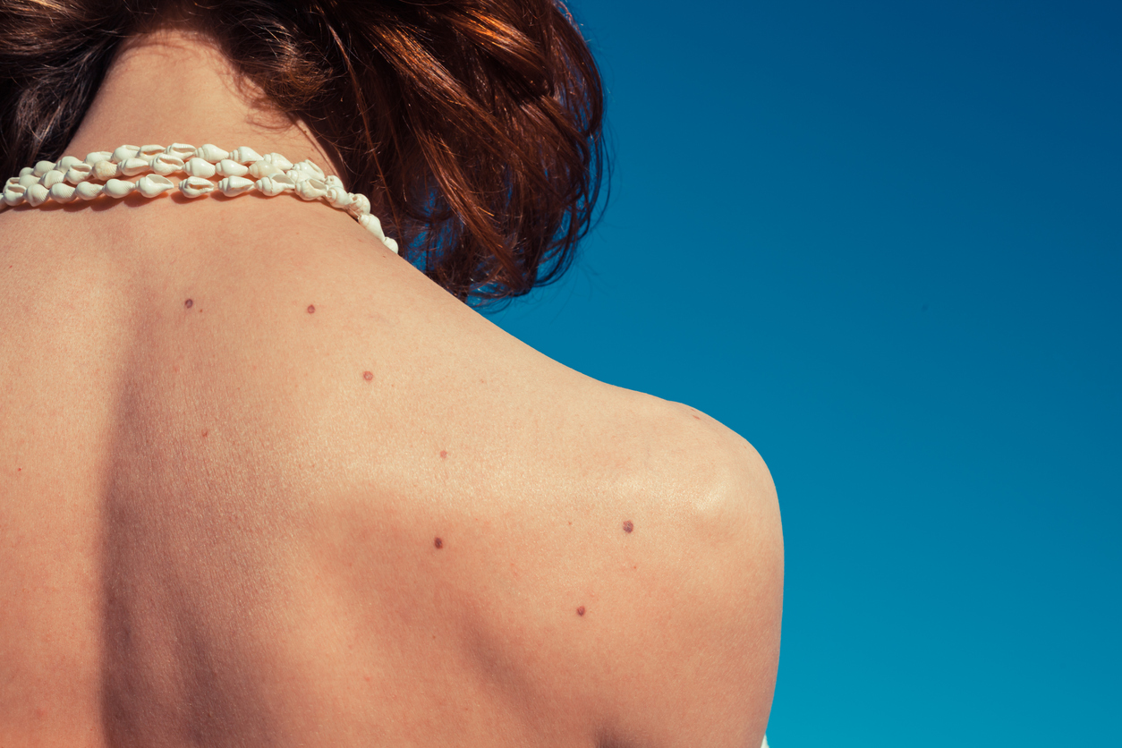 Close-up of a woman’s upper back showing several small, raised dark skin growths against a blue background.