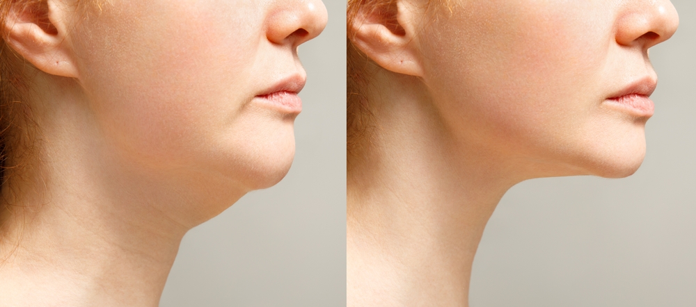 Before and after photo of a person's double chin after fat reduction treatment in Denver